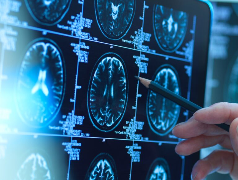 Alzheimer's Diagnosis