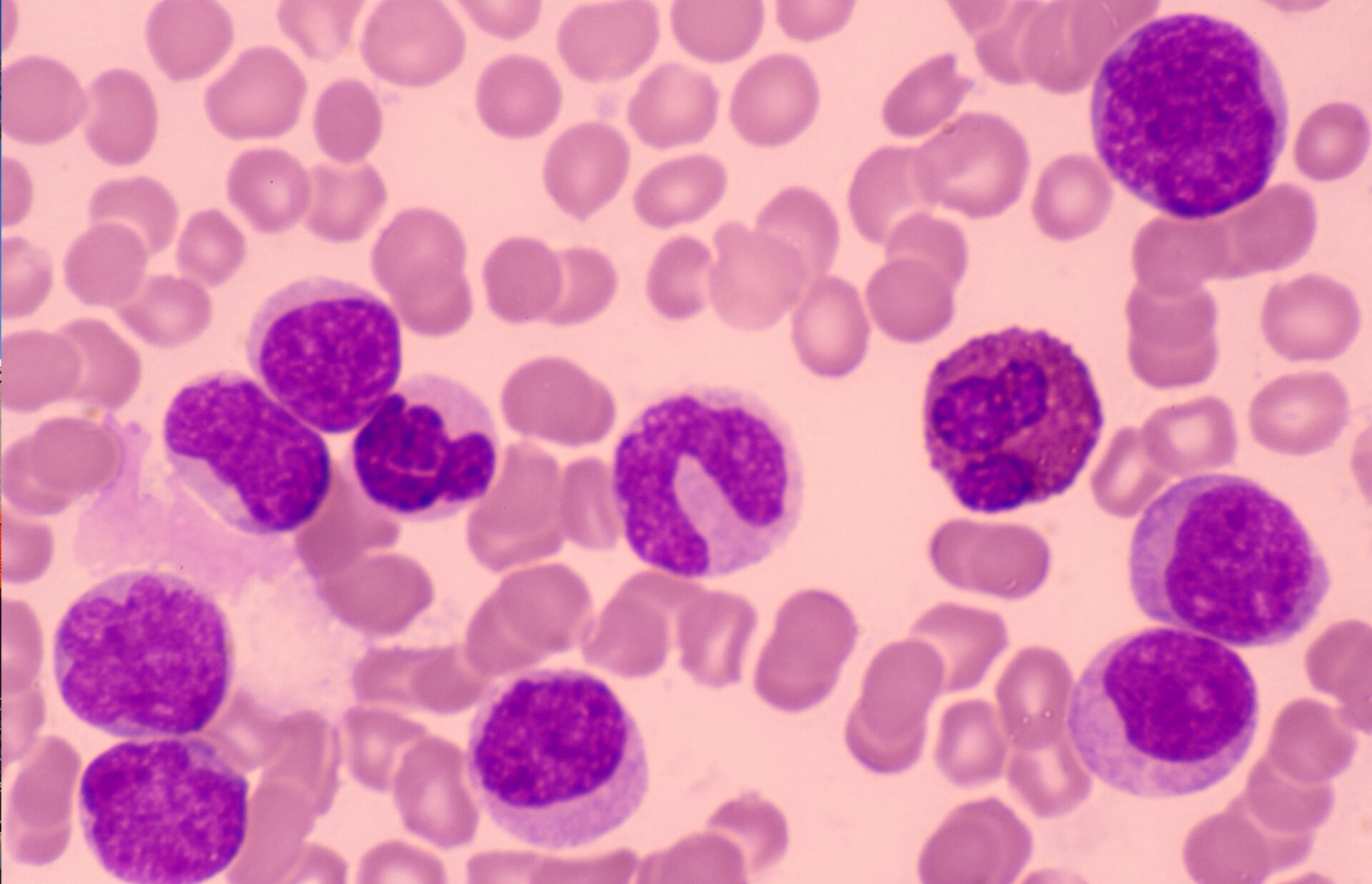 Studies Show Opening Death Gap Among Black Childhood Cancer Patients