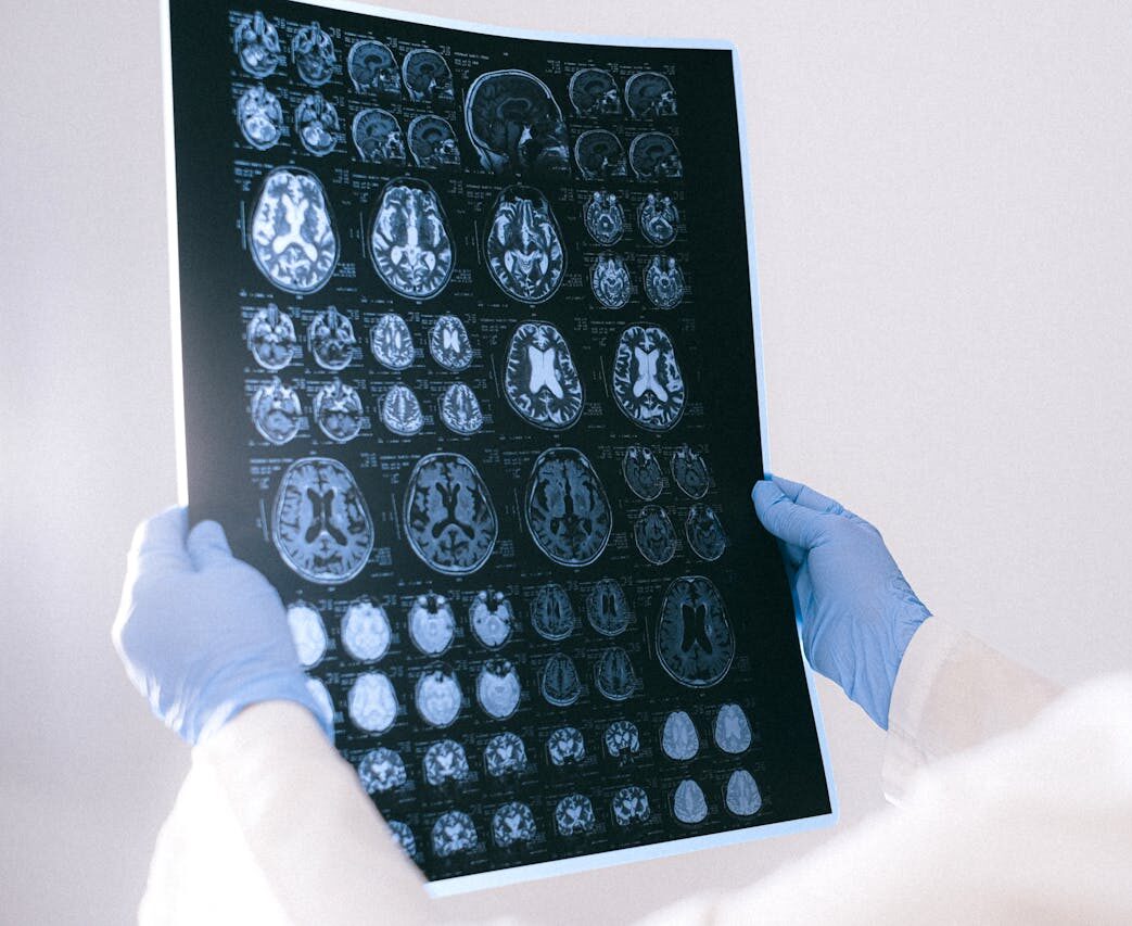 jason collins, brain tumor